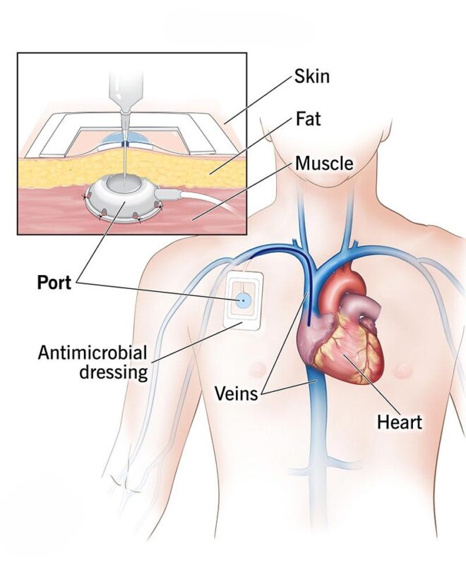 Chemo Port (Implantable Port)