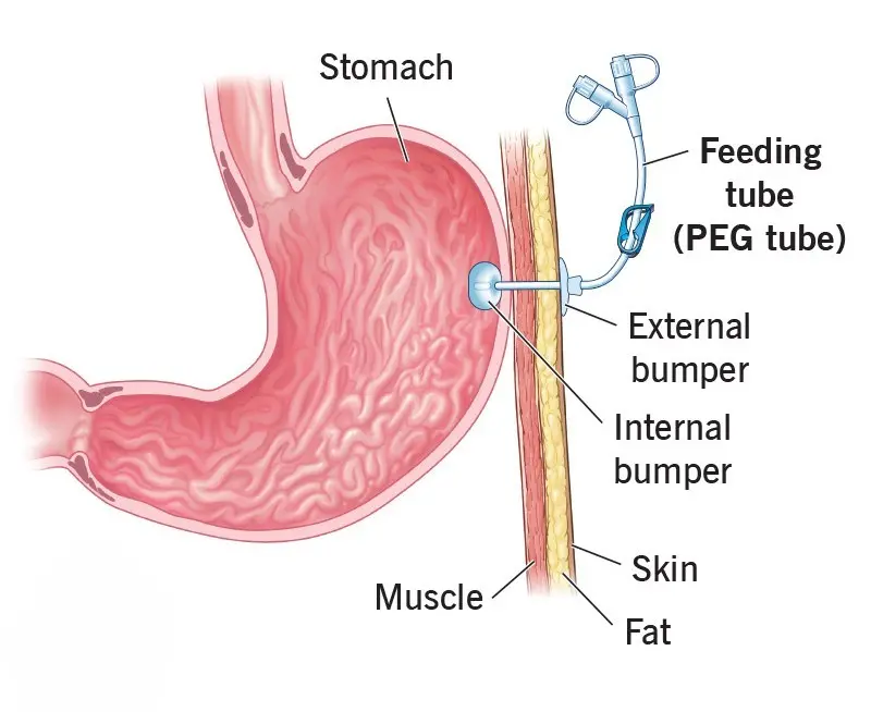 Percutaneous Gastrostomy