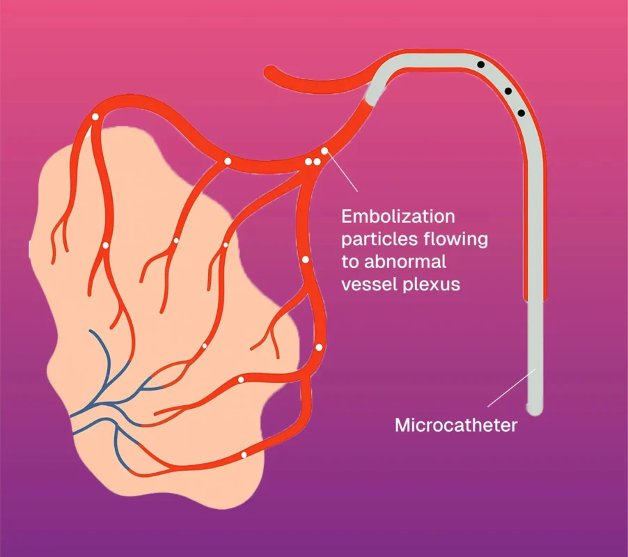 Gastrointestinal (GI) Bleed Embolization