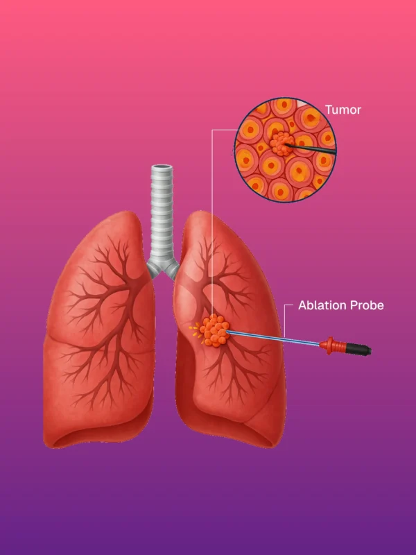 Radiofrequency Ablation (RFA) & Microwave Ablation (MWA)