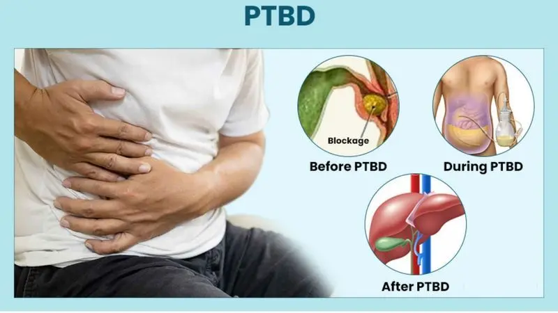 Percutaneous Transhepatic Biliary Drainage (PTBD)