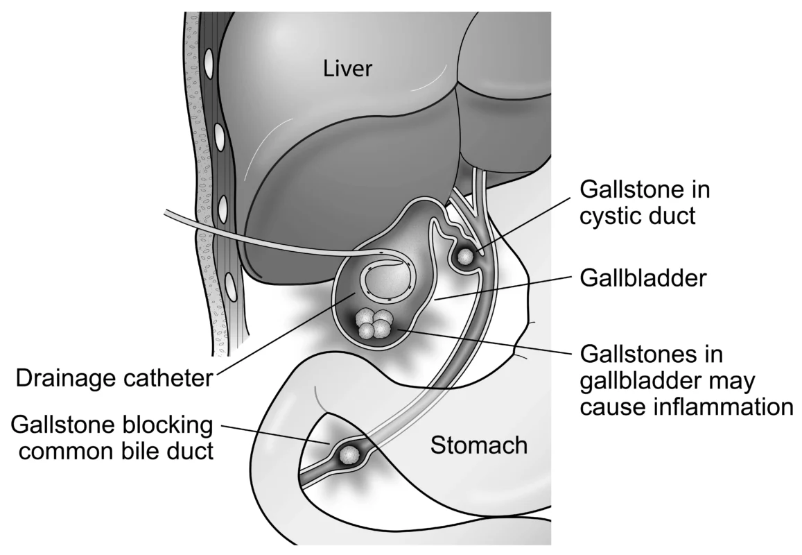 Percutaneous Cholecystostomy