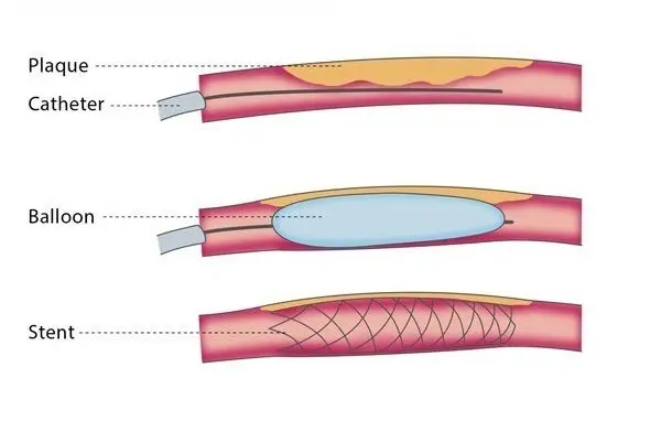 What is Stenting?