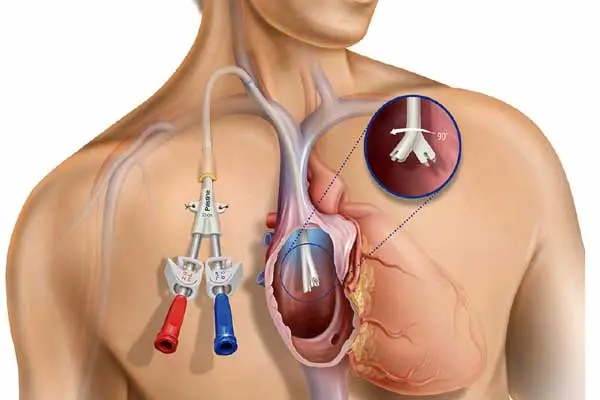 Dialysis Catheter
