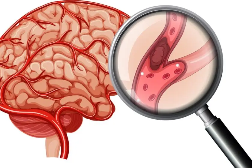 Endovascular Stroke Management