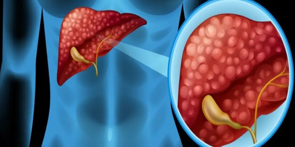 Hydatid Cyst Therapy
