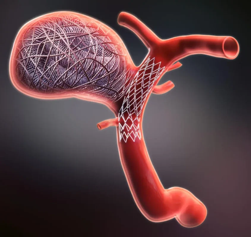 Embolization for Aneurysms