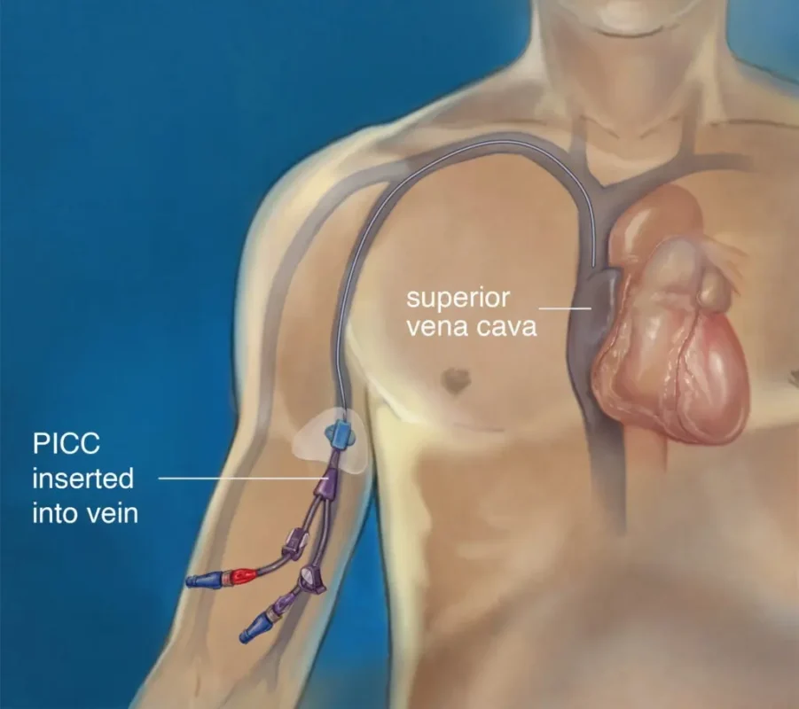 Peripherally Inserted Central Catheter (PICC Line)