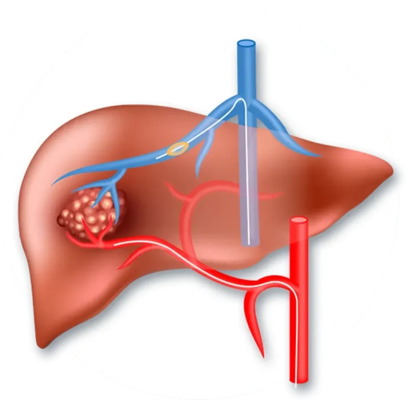 Transarterial Chemoembolization (TACE)