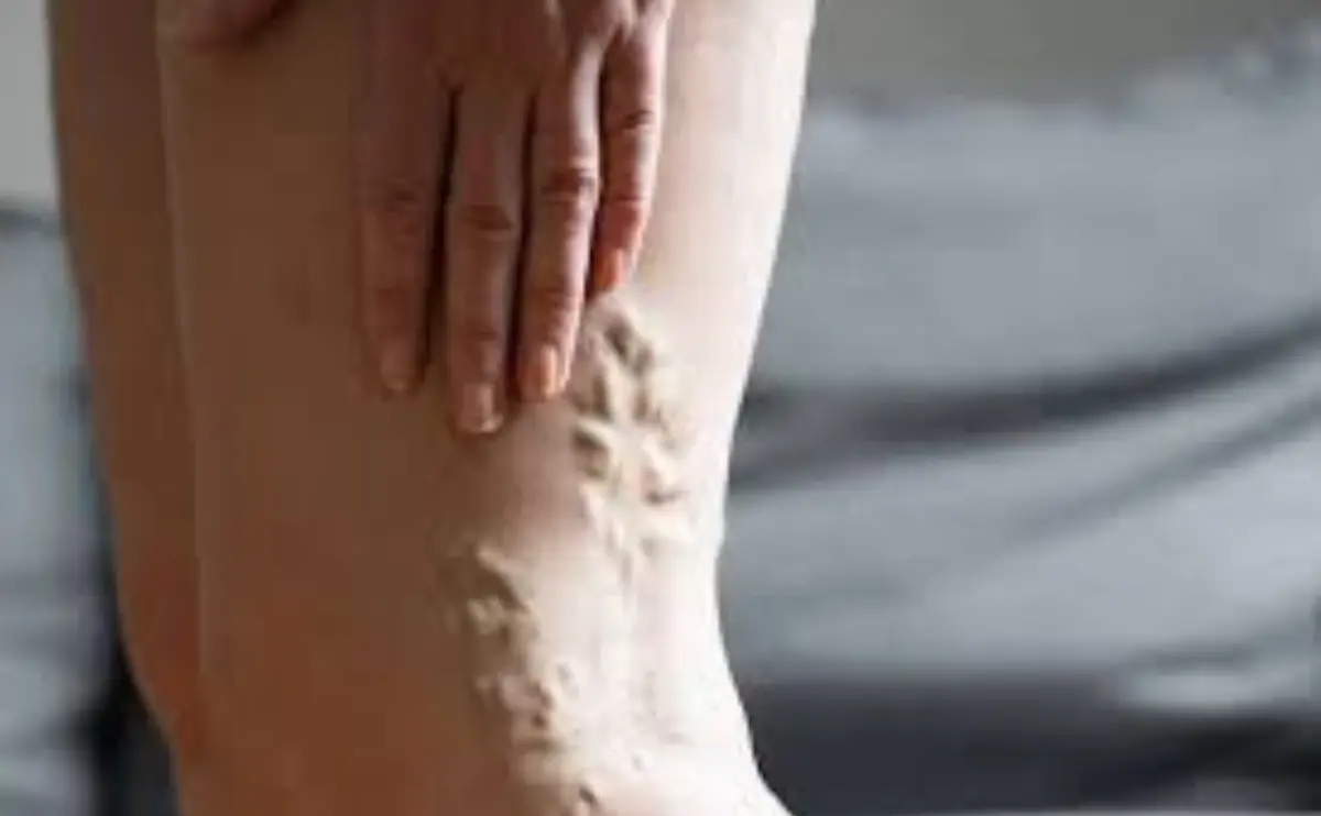 How Varicose Veins Affect Women Differently: A Deeper Look into Hormonal Influence