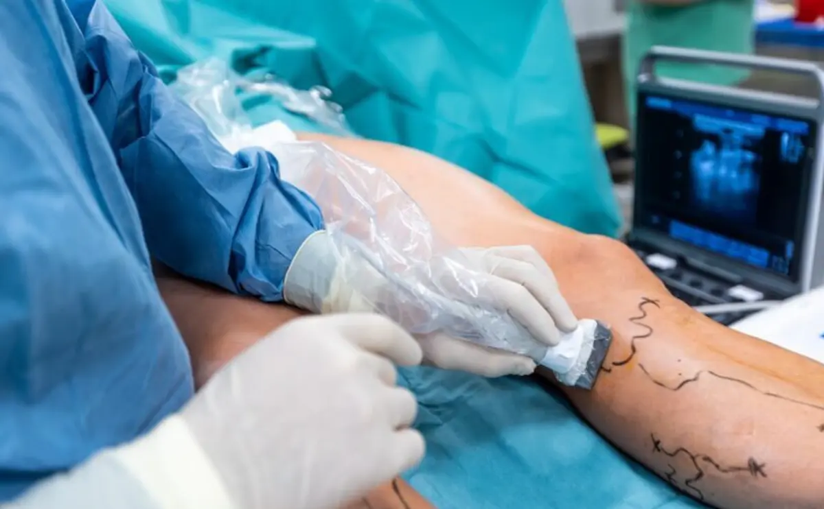 The Future of Varicose Vein Treatment: How Advanced Techniques Are Revolutionizing Care