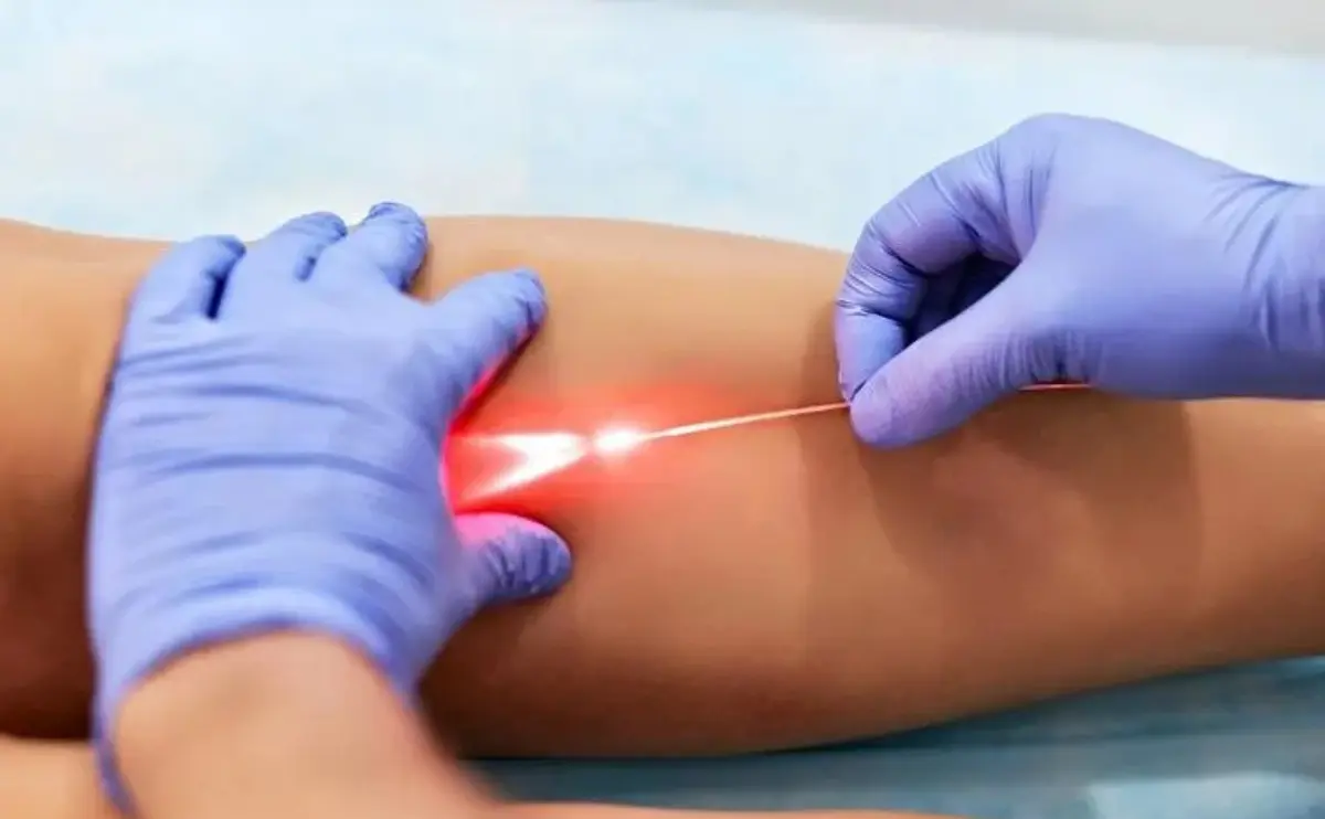 Cutting-Edge Laser Therapy for Varicose Veins: What You Need to Know