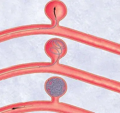 Aneurysm Coiling