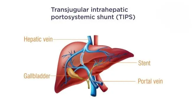 Transjugular Intrahepatic Portosystemic Shunt (TIPS)