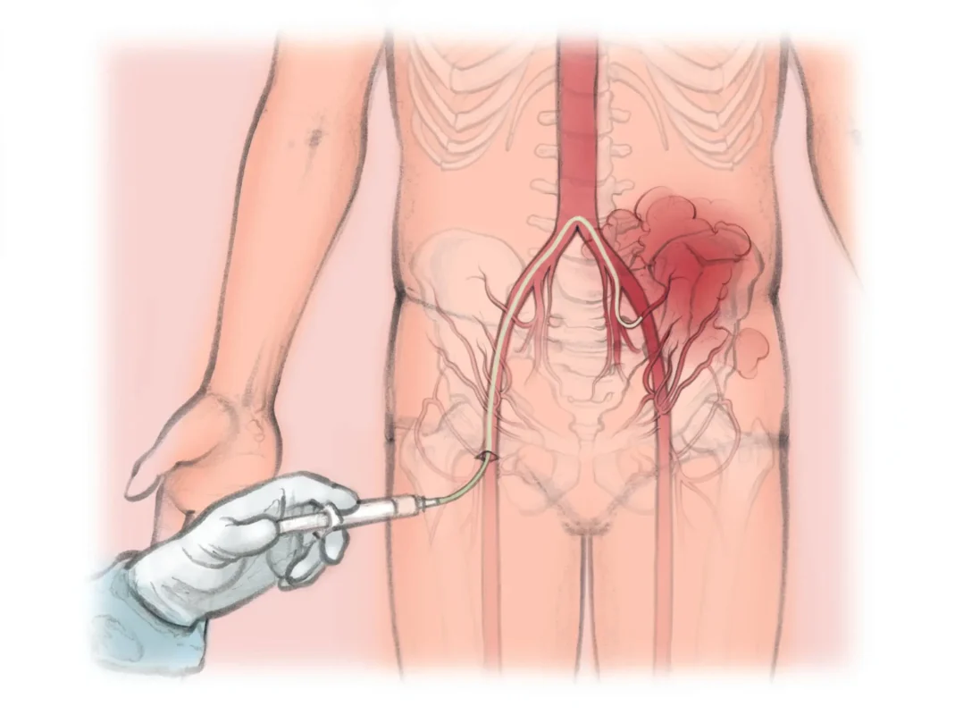 Embolization for Internal Bleeding