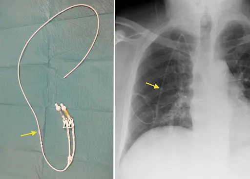 Hickman Catheter