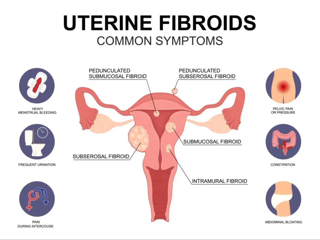 Symptoms of Uterine Fibroids