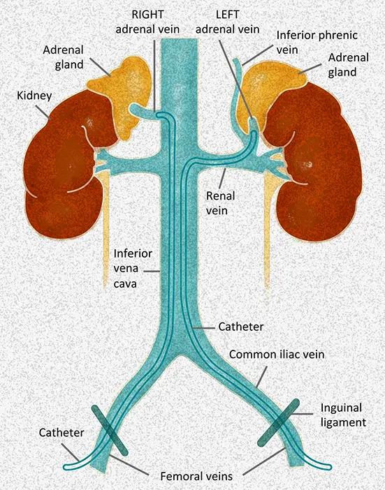 Adrenal Vein Sampling (AVS)