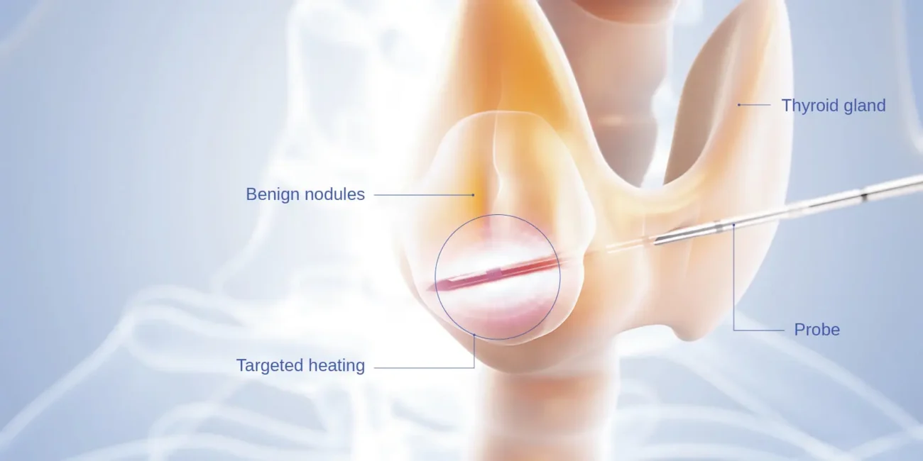 Thyroid Radiofrequency Ablation (Thyroid RFA)