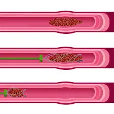 Thrombectomy