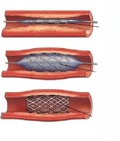 Vascular Stenting