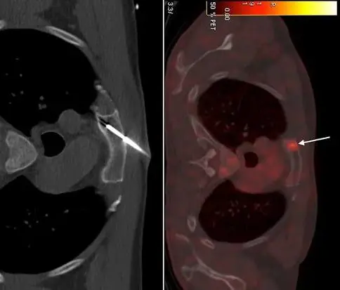 Image-Guided Biopsy
