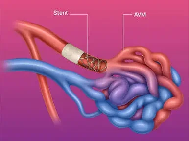 AVM Embolization