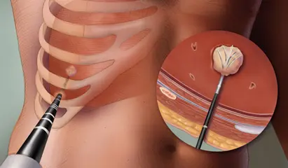 Tumor Ablation