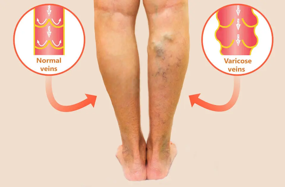 Varicose Vein Treatment