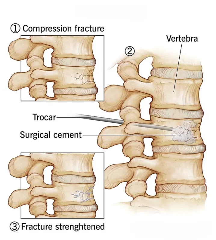 Vertebroplasty
