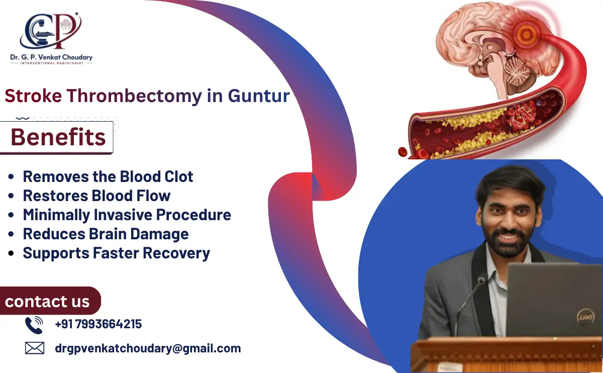 Stroke Thrombectomy: Procedure & Recovery